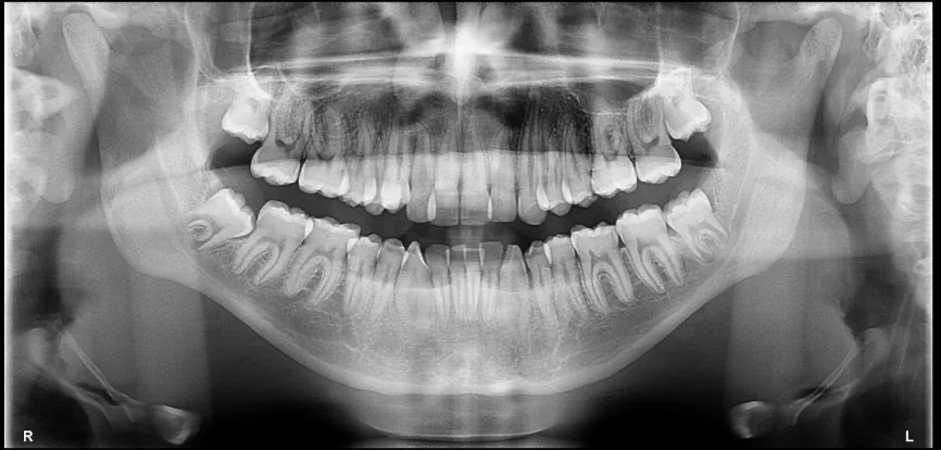 Ortopantomografía con vista completa de dientes, maxilares y articulaciones