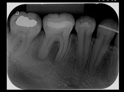 Radiografía periapical de molares inferiores