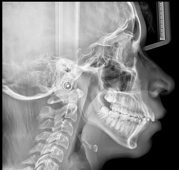 Telerradiografía lateral de cráneo con perfil blando